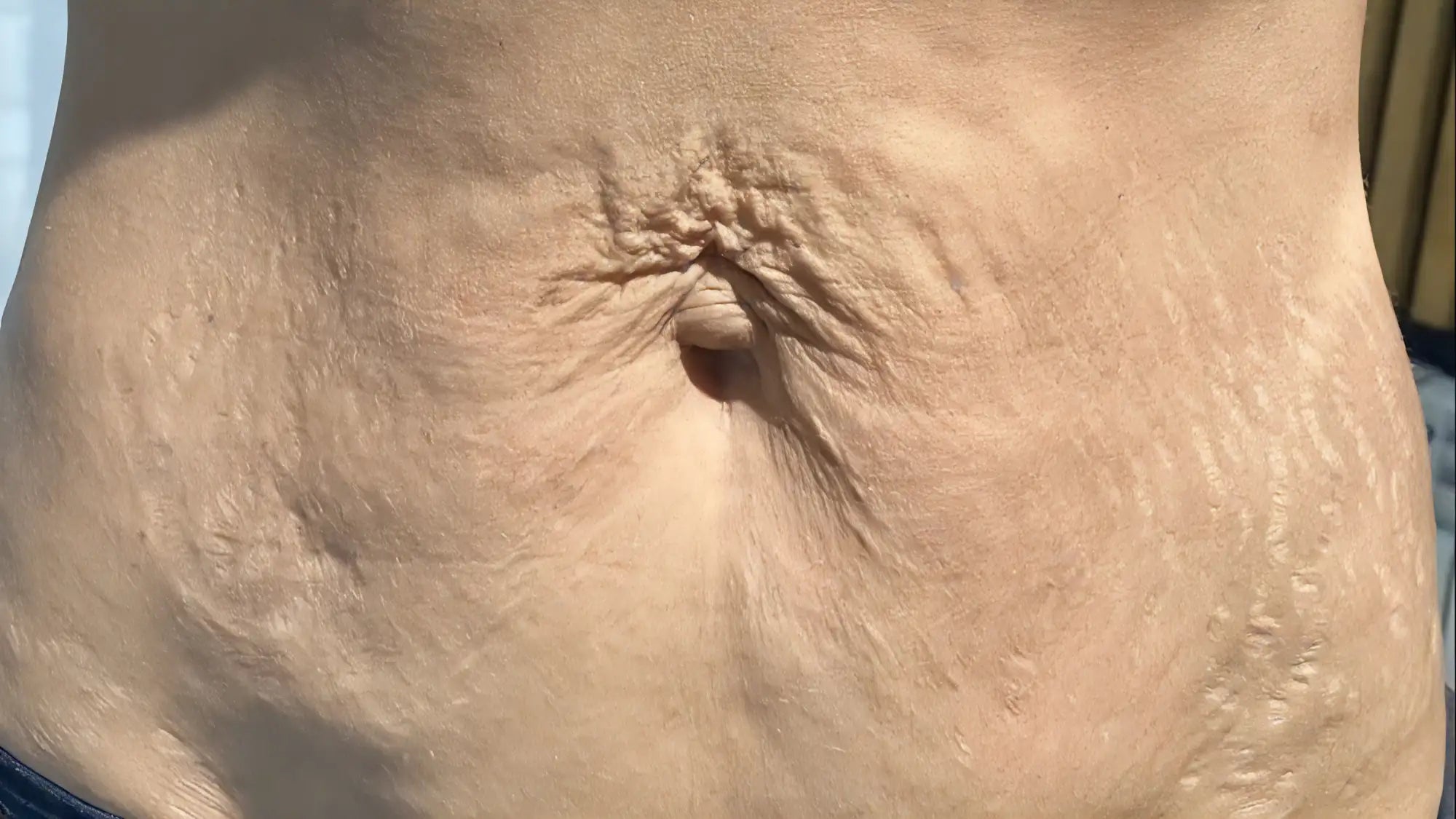 Tanned skin with visible stretch marks radiating from the navel.